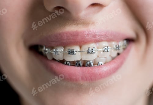 Preview: Close-up shot of teeth with braces. Female patient with metal brackets at the dental office.