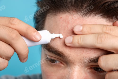 Preview: Young man with acne problem applying cream onto his face on light blue background, closeup