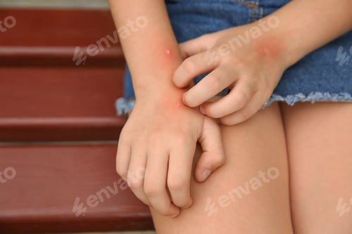 Preview: Girl scratching hand with insect bites outdoors, closeup