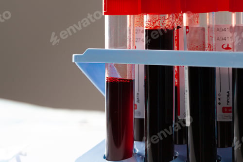 Preview: Blood test tube for analysis. 2019-nCoV virus infection originating in Wuhan, China