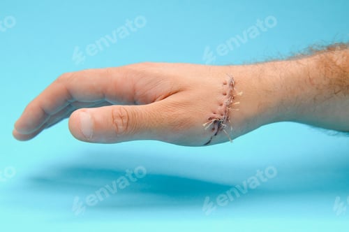 Preview: wound hand, suturing the wound. The type of cut after surgery.