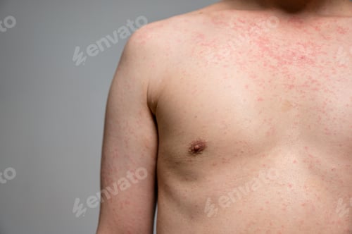 Preview: Dermatitis rash viral disease with immunodeficiency on body of young adult asian, scratch with itch