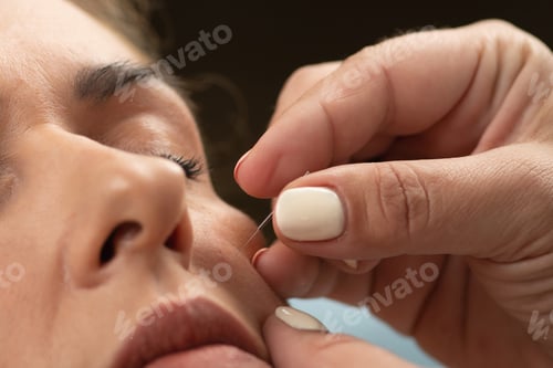 Preview: Acupuncture Treatment for Nervus Facialis