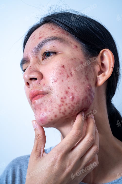 Preview: Acne on face because the disorders of sebaceous glands productions. Acne or a Cosmetic Allergy.