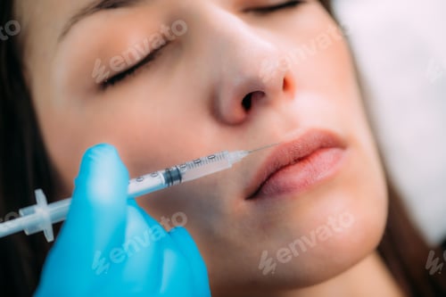 Preview: Dermal Filler for Lips