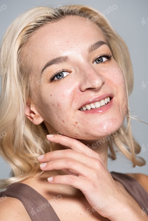 Preview: Portrait of cheerful woman with acne on skin posing isolated on grey