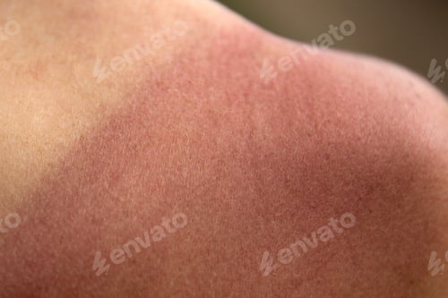 Preview: Sunburn skin