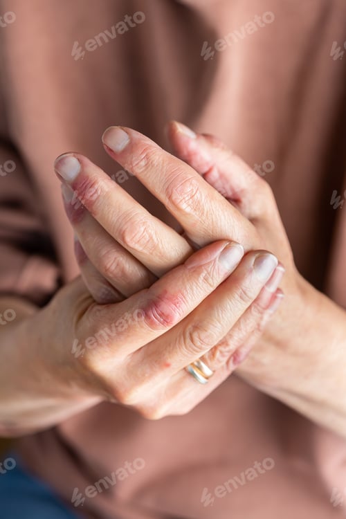 Preview: Woman hands with atopic dermatitis, eczema, allergy reaction on skin