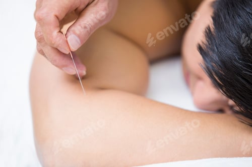 Preview: Patient receiving acupuncture