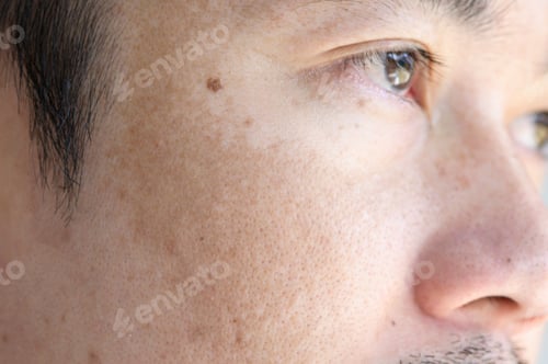 Preview: Close up Asian man face with freckles dark spots from uv light