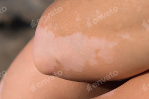 Preview: Skin with vitiligo. Female legs and arms with autoimmune disease. pigmentation