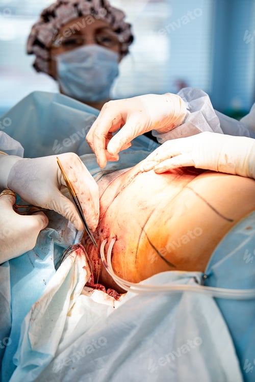 Preview: The doctor performs an operation to reconstruct the female breast. Close-up of plastic surgeon