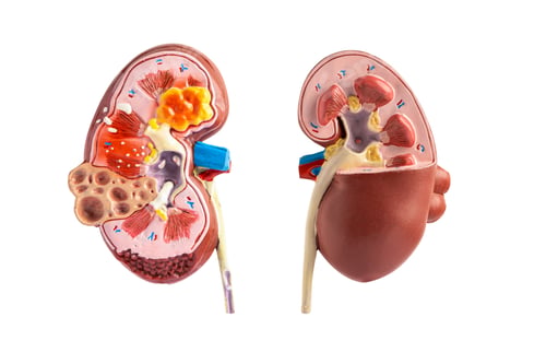 Preview: Kidney disease, Chronic kidney disease ckd, model for study isolated on white background.
