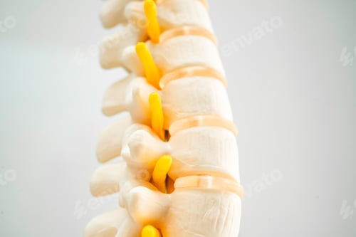 Preview: Lumbar spine displaced herniated disc fragment, spinal nerve and bone. Model for treatment medical