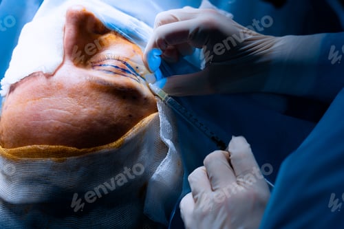 Preview: Plastic operation for eyelid skin tightening