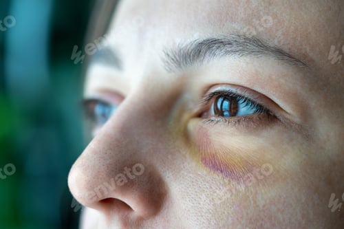 Vista previa: Beaten up woman face with bruise black eye after victim of domestic violence fight abusive relation