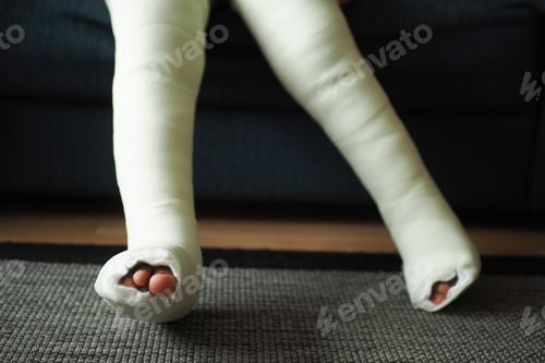 Preview: little child with plaster bandage on leg.