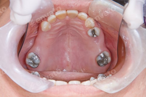 Preview: oral rehabilitation process, partial removable prosthesis