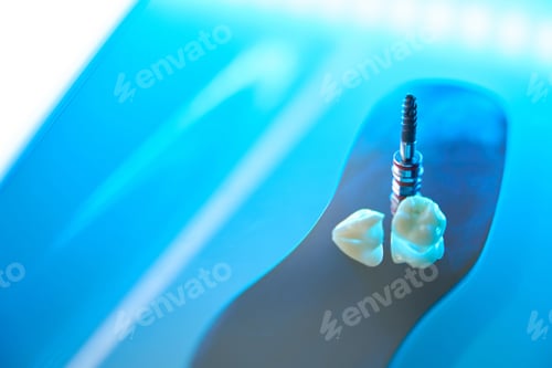 Preview: Photo of teeth and dental pin for restoration of tooth