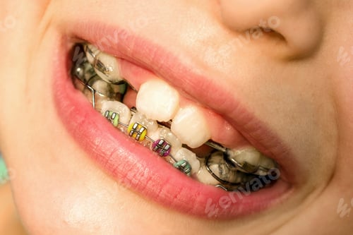Preview: Metal braces in the child mouth. Dental care. Smile with ortodontic accessories in the mouth.