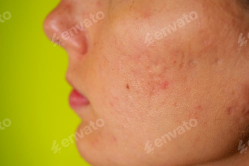 Preview: post-acne, scars and red festering pimples on the face of a young woman.