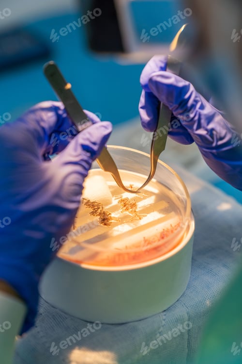 Preview: Hair surgeon making the selection of follicular units with tweezers for hair transplantation.