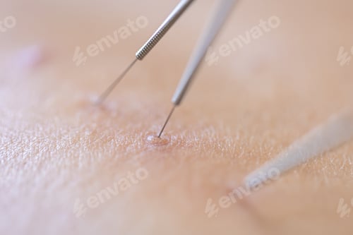 Preview: Dry needling acupuncture needles on patient, close up.