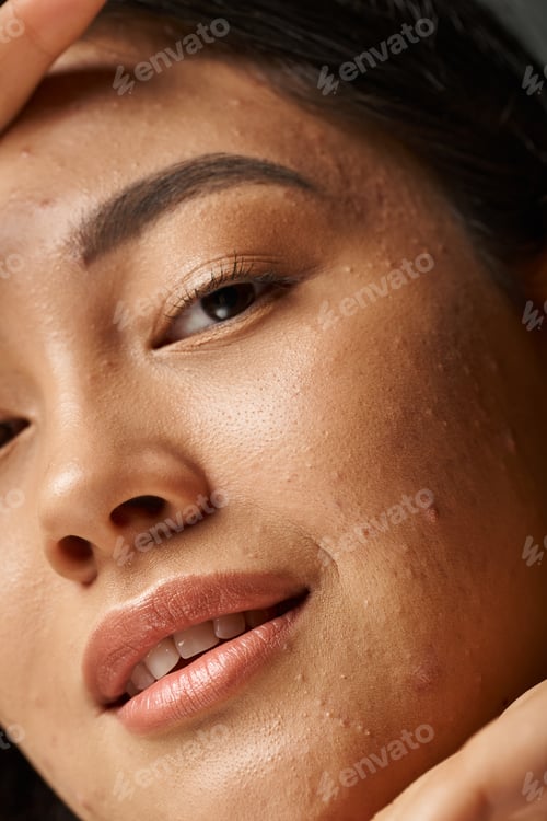 Preview: close up photo of young asian woman with acne prone skin looking at camera, skin issues concept