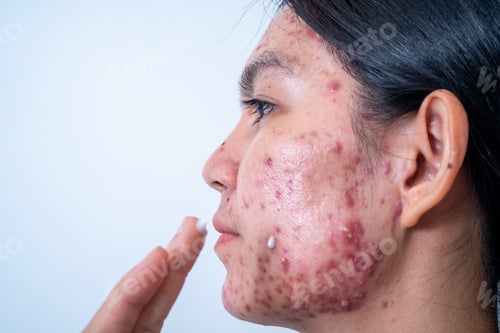Preview: Acne on face because the disorders of sebaceous glands productions. Acne or a Cosmetic Allergy.