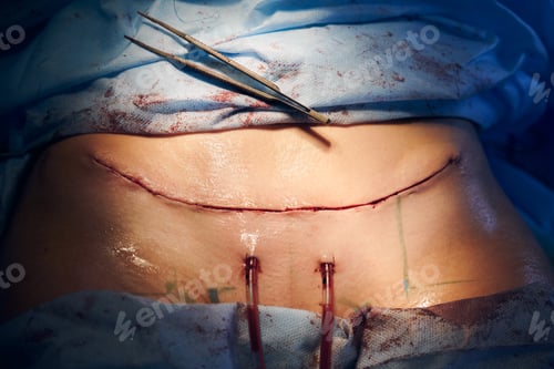 Preview: Patient abdomen with suture line after abdominoplasty surgery.
