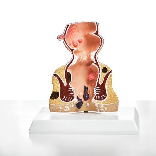 Preview: Proctology, treatment of rectum and anal intestinal diseases, hemorrhoids