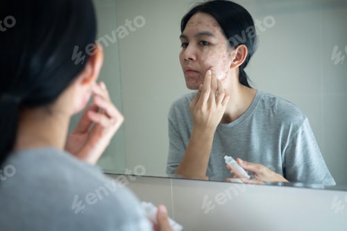 Preview: Acne on face because the disorders of sebaceous glands productions. Acne or a Cosmetic Allergy.