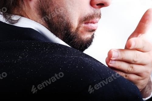 Preview: Dandruff Issue On Man'S Sholder