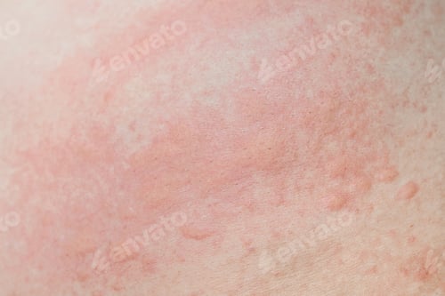Preview: Allergic skin rash prickly heat skin red dot closeup skin problem itching
