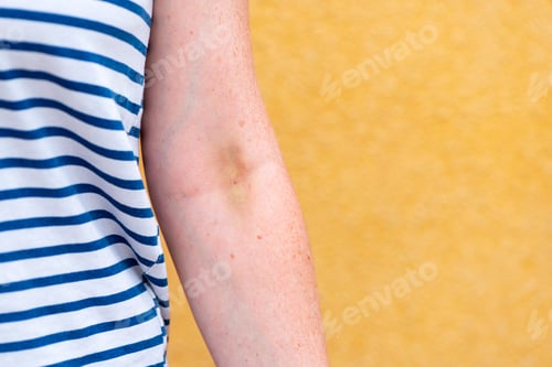 Preview: Vein hematoma on female hand after phlebotomy