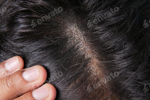 Preview: men with dandruff in his hair, closeup