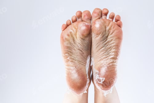 Preview: dehydrated skin female heels