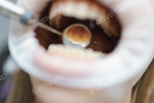 Preview: Close-up dental mirror in the mouth. Macro photography of the process of examining teeth