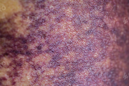 Preview: Asian woman dark bruise on the buttocks from a slip accident in the bathroom, close up view.
