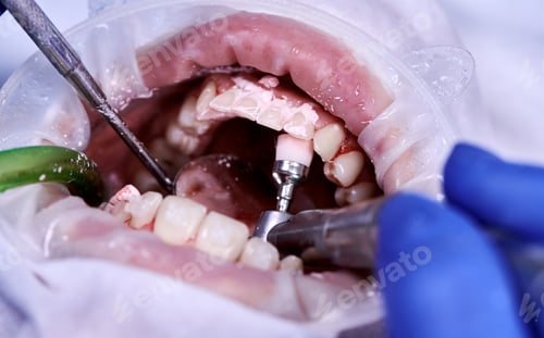 Preview: Close-up picture of a woman's mouth during dental procedure of cleaning teeth