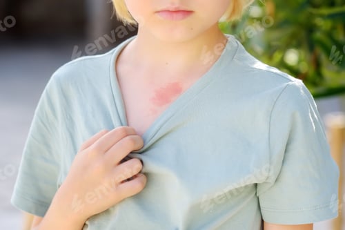 Preview: Mark on the skin of chest of eight years old child. Hemangioma