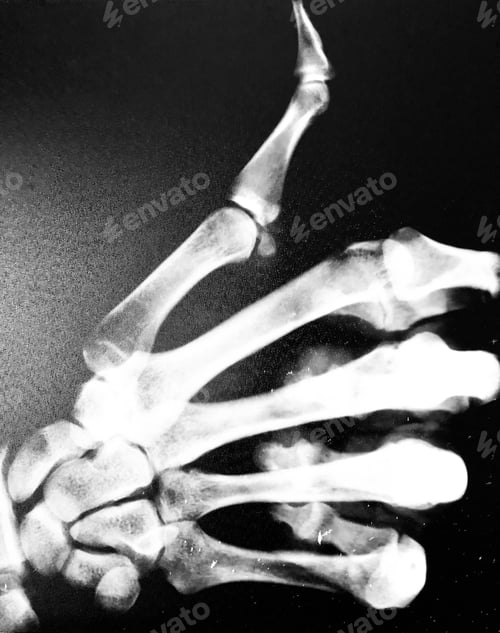 Preview: X-ray of a hand doing the thumbs up gesture.