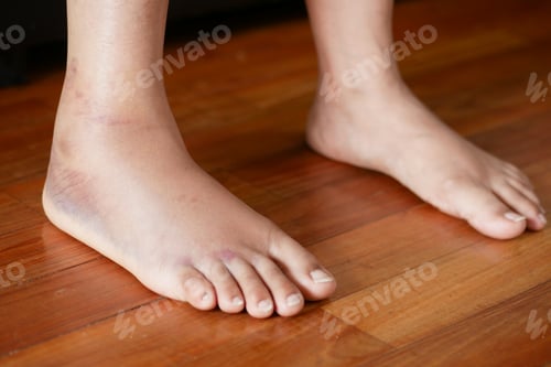 Preview: close up of women feet with swelling