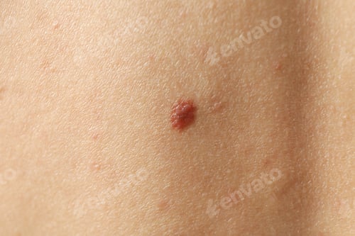 Preview: Concept of body care with skin with mole