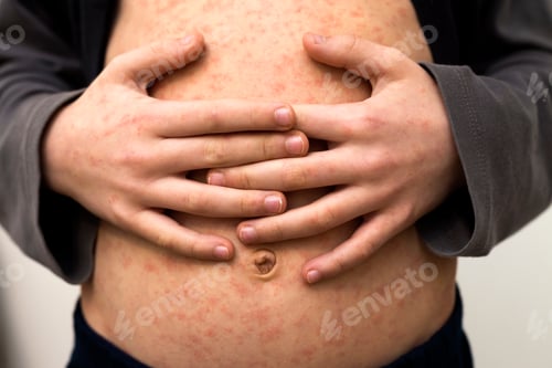 Preview: Sick child body, stomach with red rush spots from measles or chicken pox.