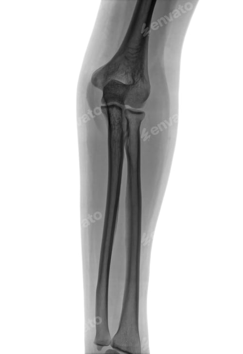 Preview: Elbow X-ray negative