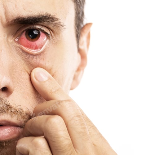 Preview: Man with the Subconjunctival hemorrhage in his eye