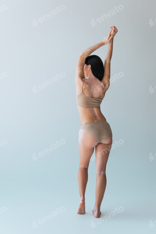 Preview: back view of brunette young woman with vitiligo posing in beige lingerie on grey