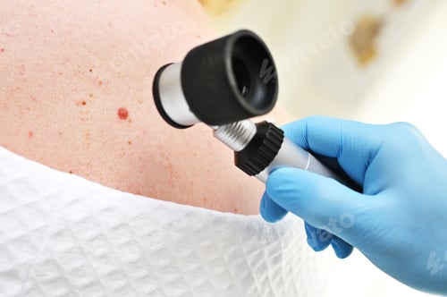 Preview: a dermatologist examines moles and skin growths on the patient's body using a special device - a