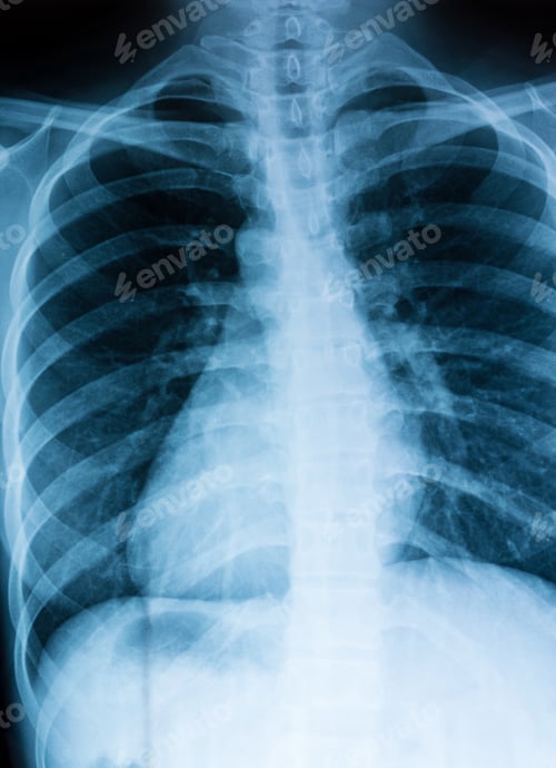 Preview: Chest xray scan